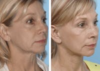 Dr. Balikian's Facelift Before & After Gallery - Patient 2167373 - Image 1