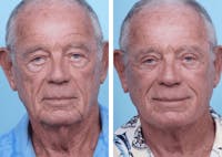 Dr. Balikian's Facelift Before & After Gallery - Patient 2167375 - Image 1