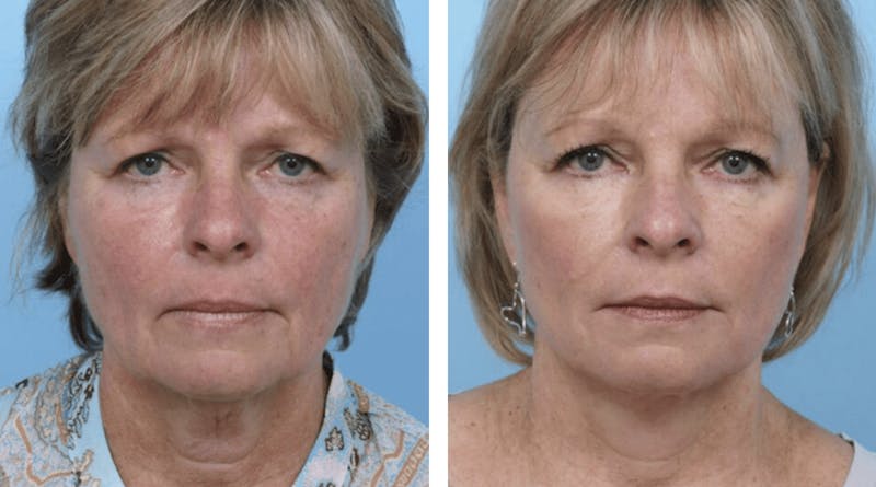 Dr. Balikian's Facelift Gallery - Patient 2167391 - Image 1