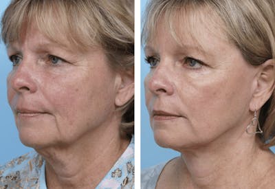 Dr. Balikian's Facelift Before & After Gallery - Patient 2167391 - Image 2