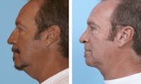Dr. Balikian's Facelift Before & After Gallery - Patient 2167393 - Image 1