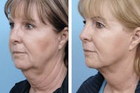 Dr. Balikian's Facelift Before & After Gallery - Patient 2167403 - Image 1