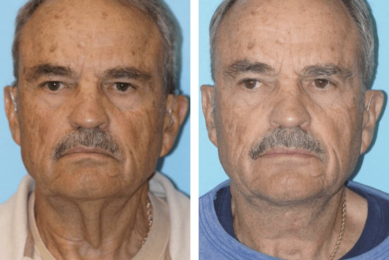 Dr. Balikian's Facelift Before & After Gallery - Patient 2167407 - Image 1