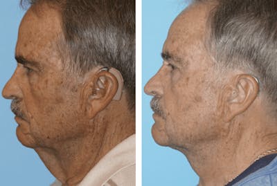 Dr. Balikian's Facelift Before & After Gallery - Patient 2167407 - Image 2