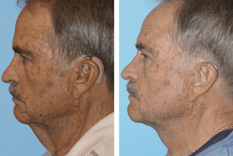 Dr. Balikian's Facelift Before & After Gallery - Patient 2167407 - Image 2