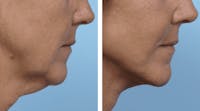 Dr. Balikian's Facelift Before & After Gallery - Patient 2167411 - Image 1