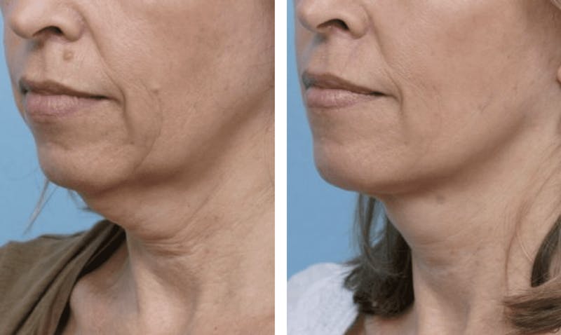 Dr. Balikian's Facelift Before & After Gallery - Patient 2167414 - Image 1