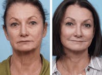 Dr. Balikian's Facelift Before & After Gallery - Patient 2167416 - Image 1