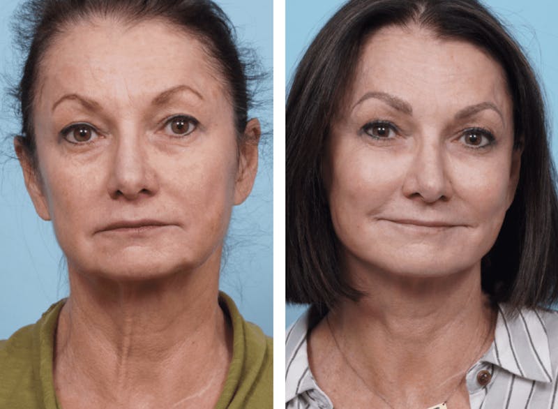 Dr. Balikian's Facelift Gallery - Patient 2167416 - Image 1