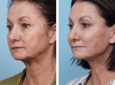 Dr. Balikian's Facelift Before & After Gallery - Patient 2167416 - Image 2