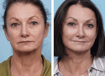 Dr. Balikian's Facelift Before & After Gallery - Patient 2167418 - Image 1