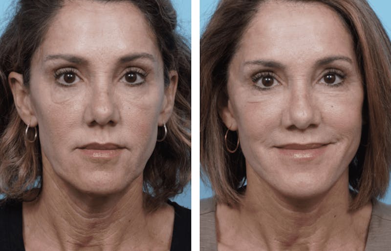 Dr. Balikian's Facelift Before & After Gallery - Patient 2167421 - Image 1