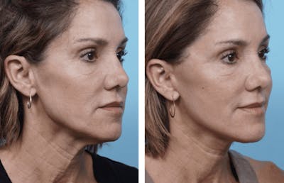 Dr. Balikian's Facelift Before & After Gallery - Patient 2167421 - Image 2