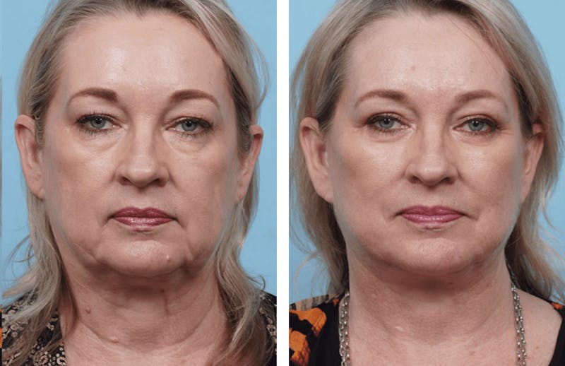 Dr. Balikian's Facelift Gallery - Patient 2167423 - Image 1