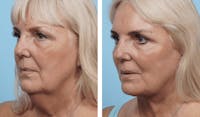 Dr. Balikian's Facelift Before & After Gallery - Patient 2167425 - Image 1