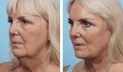 Dr. Balikian's Facelift Before & After Gallery - Patient 2167425 - Image 1