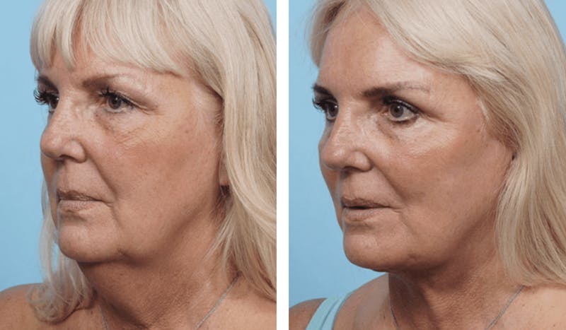 Dr. Balikian's Facelift Before & After Gallery - Patient 2167425 - Image 1