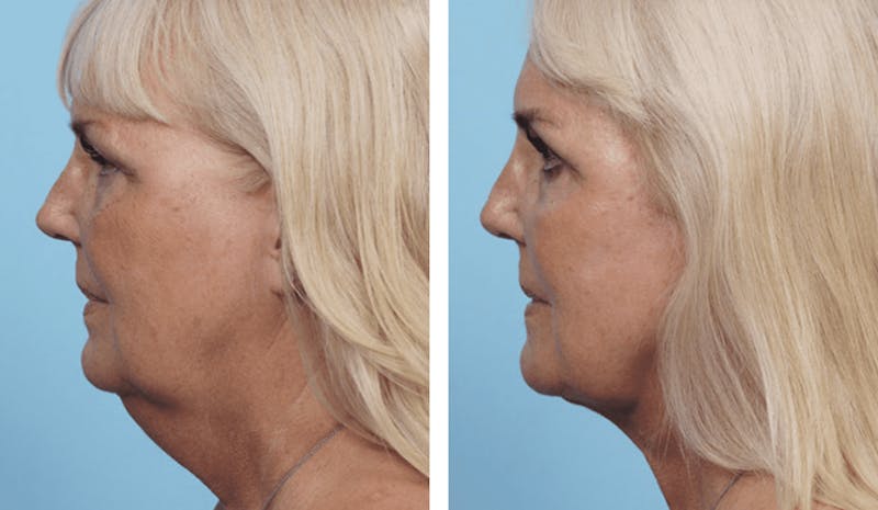 Dr. Balikian's Facelift Before & After Gallery - Patient 2167425 - Image 2