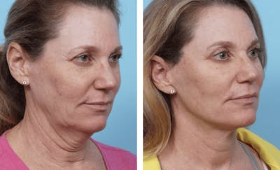 Dr. Balikian's Facelift Before & After Gallery - Patient 2167427 - Image 1