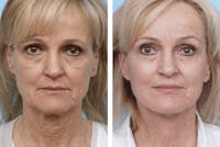 Dr. Balikian's Facelift Before & After Gallery - Patient 2167432 - Image 1