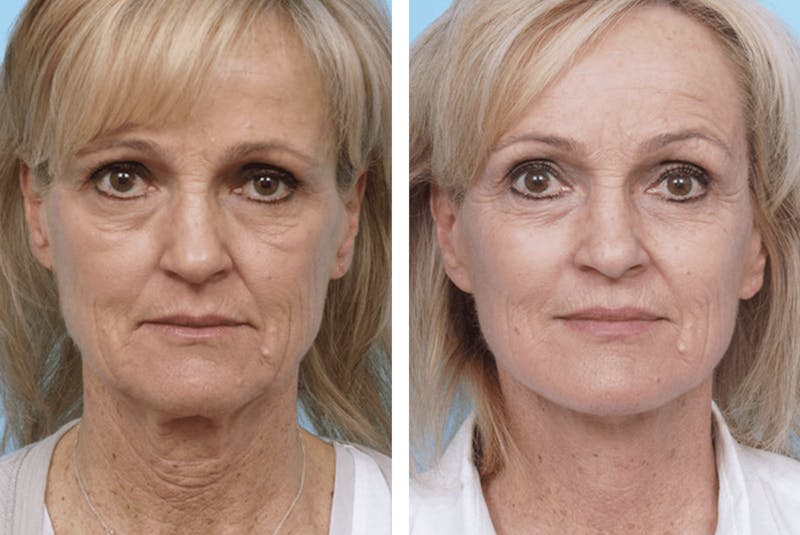 Dr. Balikian's Facelift Before & After Gallery - Patient 2167432 - Image 1