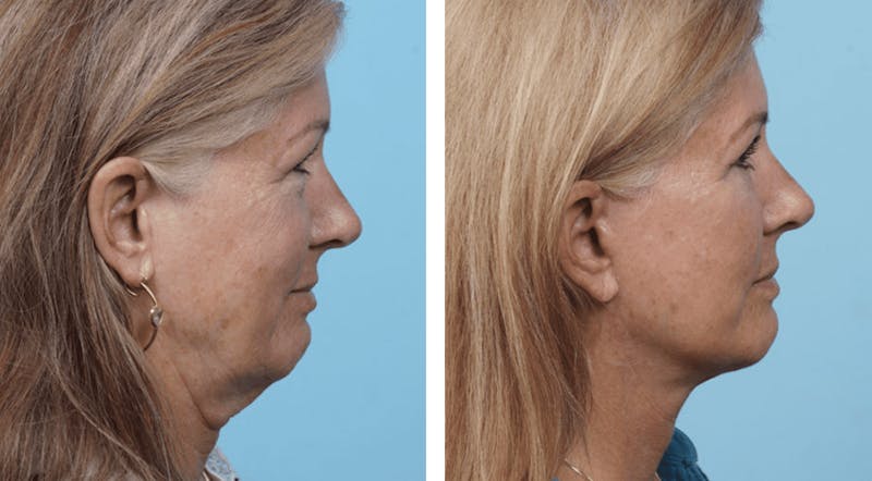 Dr. Balikian's Facelift Before & After Gallery - Patient 2167434 - Image 1
