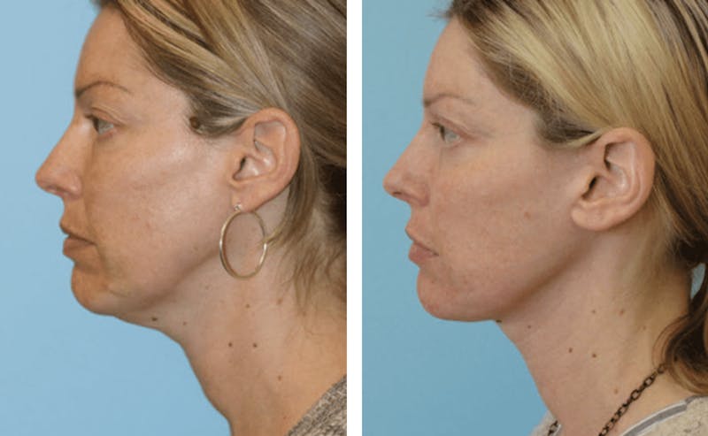 Dr. Balikian's Facelift Before & After Gallery - Patient 2167436 - Image 1