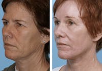 Dr. Balikian's Facelift Before & After Gallery - Patient 2167438 - Image 1