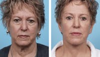 Dr. Balikian's Facelift Before & After Gallery - Patient 2167440 - Image 1