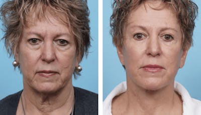 Dr. Balikian's Facelift Before & After Gallery - Patient 2167440 - Image 1