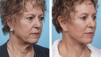Dr. Balikian's Facelift Before & After Gallery - Patient 2167440 - Image 2
