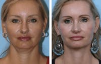 Dr. Balikian's Facelift Before & After Gallery - Patient 2167442 - Image 1