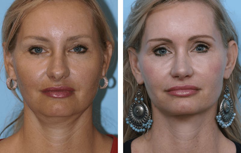 Dr. Balikian's Facelift Before & After Gallery - Patient 2167442 - Image 1