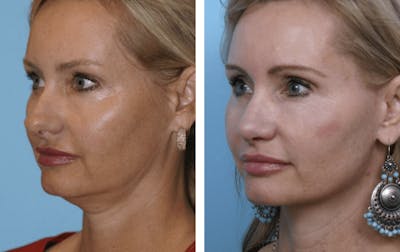 Dr. Balikian's Facelift Before & After Gallery - Patient 2167442 - Image 2