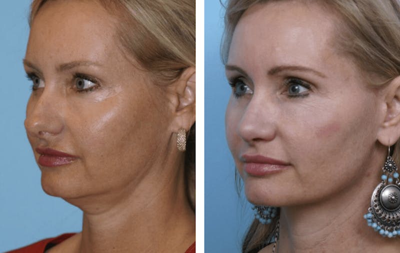 Dr. Balikian's Facelift Before & After Gallery - Patient 2167442 - Image 2