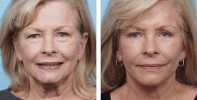 Dr. Balikian's Facelift Before & After Gallery - Patient 2167446 - Image 1