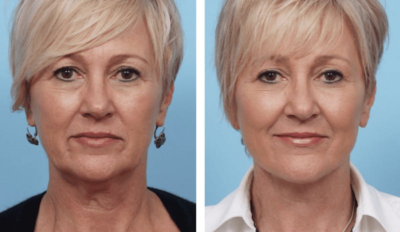 Dr. Balikian's Facelift Before & After Gallery - Patient 2167449 - Image 1