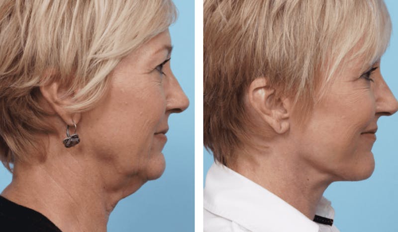 Dr. Balikian's Facelift Gallery - Patient 2167449 - Image 2