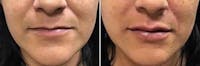 Dr. Balikian's Lip Augmentation Before & After Gallery - Patient 2167459 - Image 1