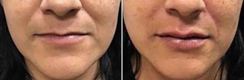 Dr. Balikian's Lip Augmentation Before & After Gallery - Patient 2167459 - Image 1