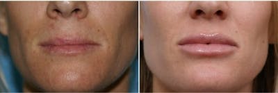 Dr. Balikian's Lip Augmentation Before & After Gallery - Patient 2167461 - Image 1