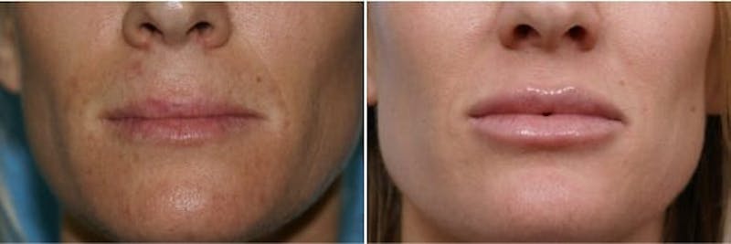 Dr. Balikian's Lip Augmentation Before & After Gallery - Patient 2167461 - Image 1