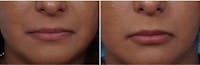 Dr. Balikian's Lip Augmentation Before & After Gallery - Patient 2167463 - Image 1