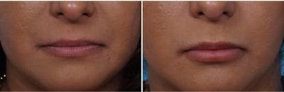 Dr. Balikian's Lip Augmentation Before & After Gallery - Patient 2167463 - Image 1