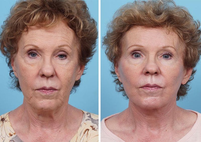 Dr. Balikian's Laser / Chemical Peel Before & After Gallery - Patient 2167478 - Image 1