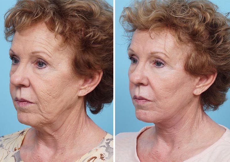 Dr. Balikian's Laser / Chemical Peel Before & After Gallery - Patient 2167478 - Image 2