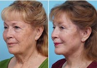Dr. Balikian's Laser / Chemical Peel Before & After Gallery - Patient 2167479 - Image 1