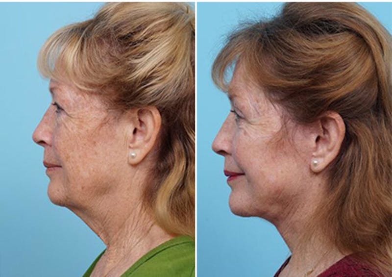 Dr. Balikian's Laser / Chemical Peel Before & After Gallery - Patient 2167479 - Image 2