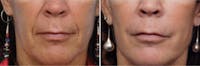 Dr. Balikian's Laser / Chemical Peel Before & After Gallery - Patient 2167482 - Image 1
