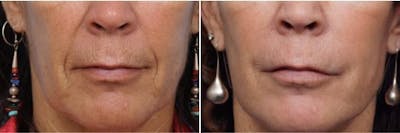 Dr. Balikian's Laser / Chemical Peel Before & After Gallery - Patient 2167482 - Image 1